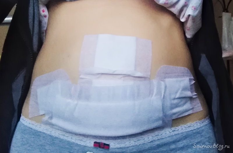 Множественная миома — моя история Множественная миома — моя история